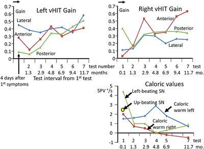 Functional Testing of Vestibulo-Spinal Contributions to Balance Control: Insights From Tracking Improvement Following Acute Bilateral Peripheral Vestibular Loss